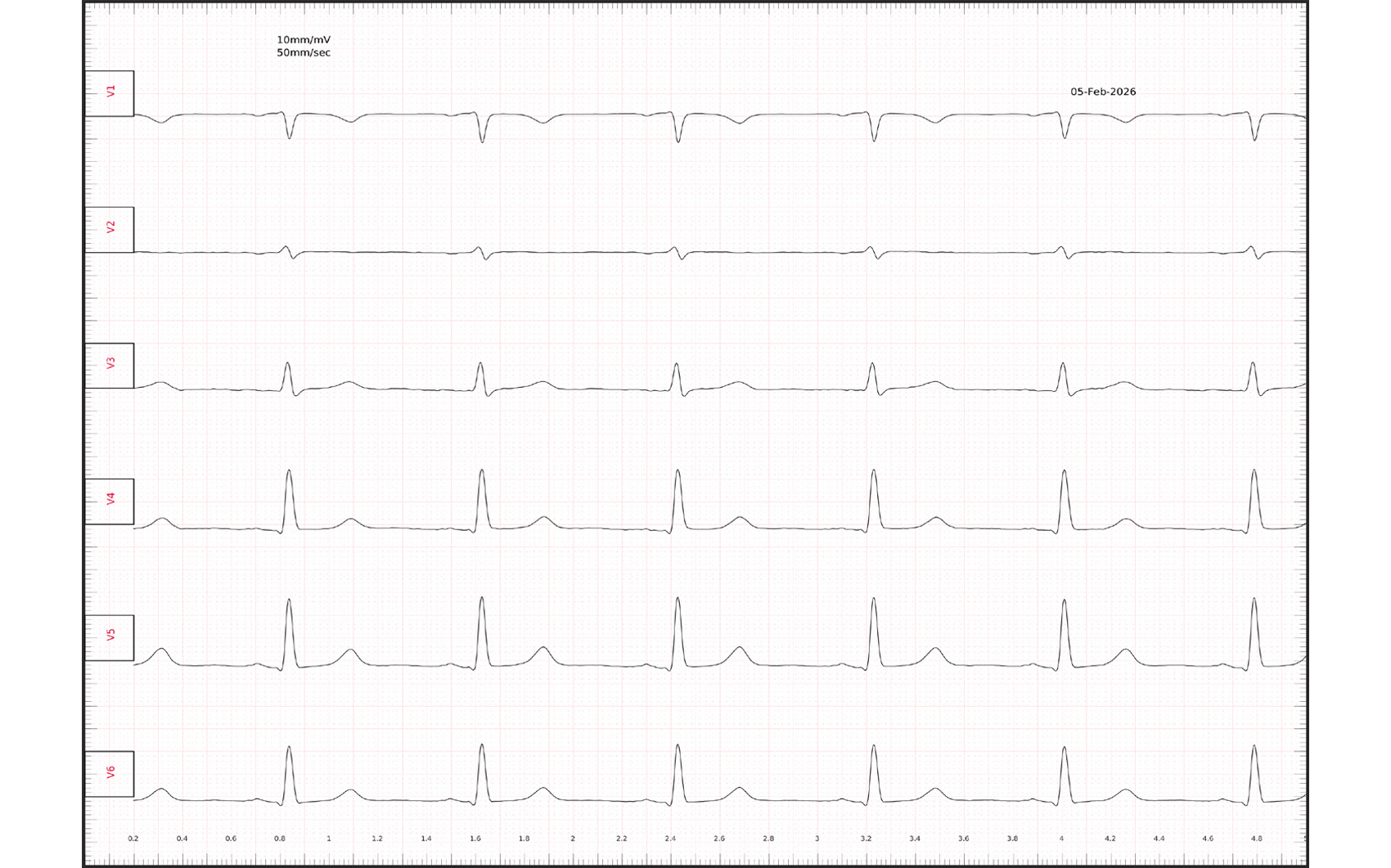 Registro de un ECG convencional de 12 derivaciones