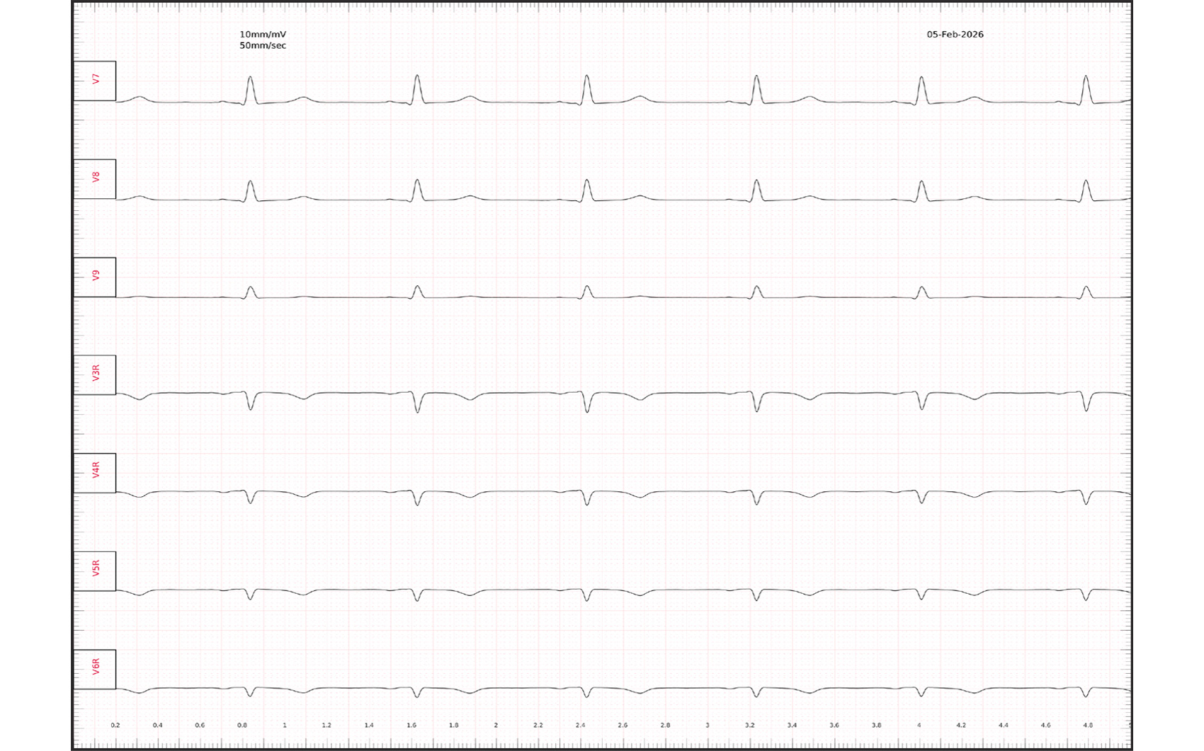 Ableitung eines extended leads V7-V9 sowie Vr3-Vr6 (ESC-Guidelinekonform).